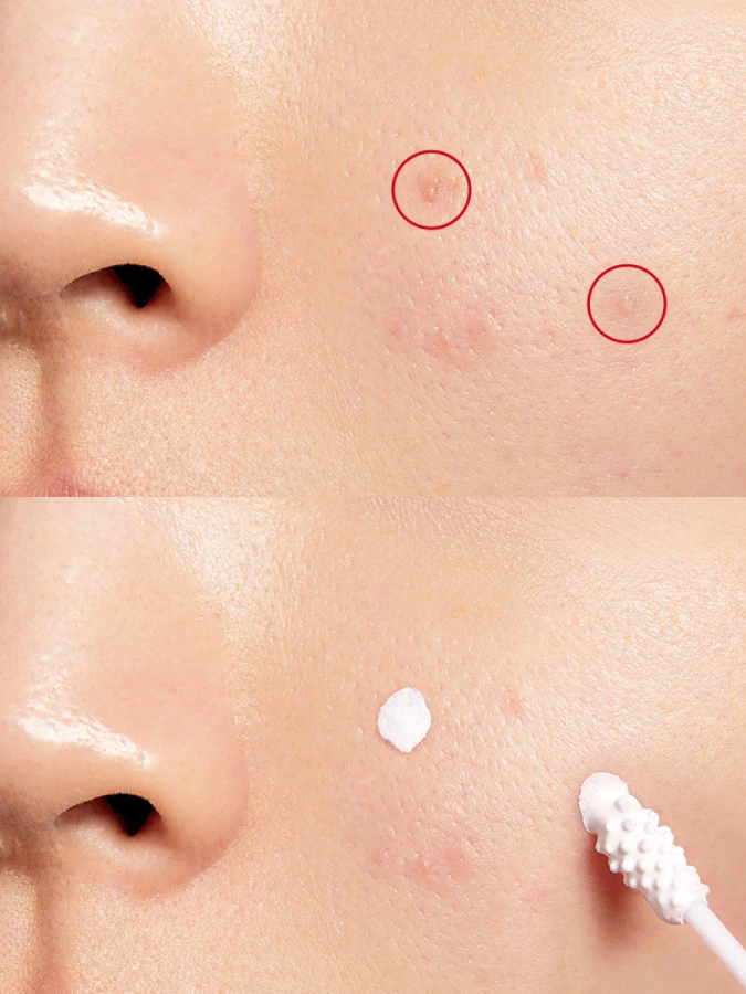 Точечное двухфазное средство против воспалений с каламином COSRX AC Collection Blemish Spot Drying Lotion Kit