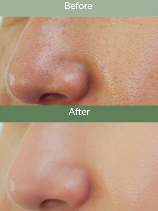 Жидкая маска для очищения сальных нитей Dr.Althea Premium Quick Step Sebum Cleanser